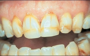 a image showing brown stains on teeth