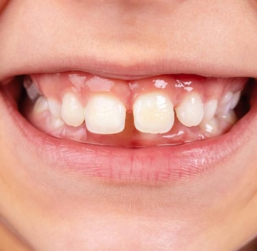 a image showing smiling teeth with gap between front upeer teeth