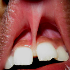 a image showing midline diastema between incisors and frenal attachment