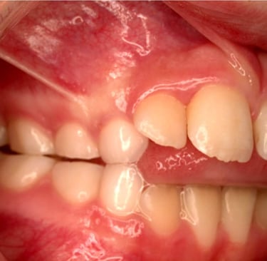 a image showing tongue thrusting between incisors