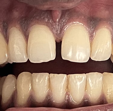 a image showing teeth with  midline diastema