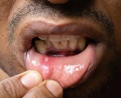 an image showing canker sore/ mouth ulcer in the lips