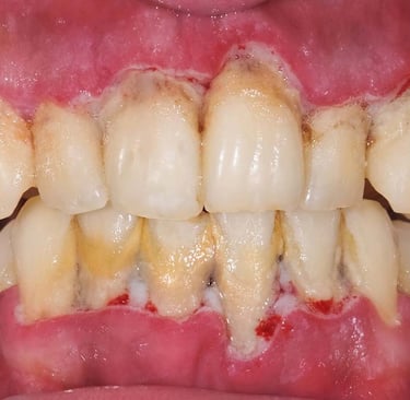 calculus formed on teeth with swollen gums