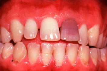 a image showing pink tooth 