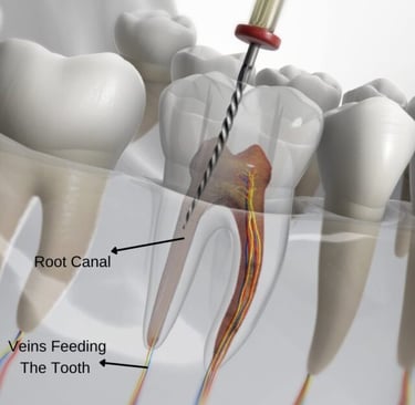 a image showing root canal in molar teeth and file inserted in root canal