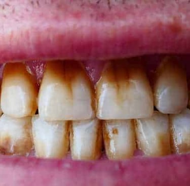 a image showing smokers teeth stains