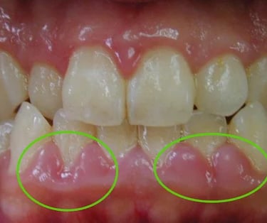 a image showing swollen gums
