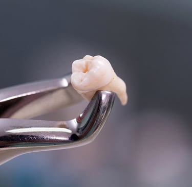 a image showing extracted molar teeth in forceps