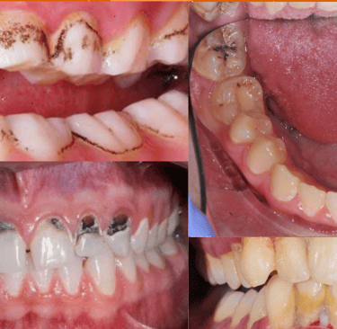 black spots on teeth 