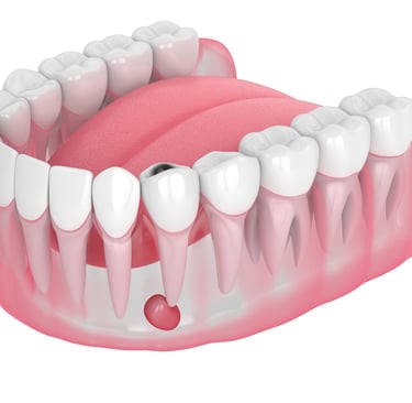 an image showing teeth with abscess