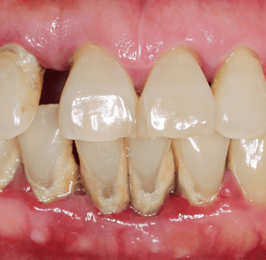 an image showing teeth with plaque and calculus
