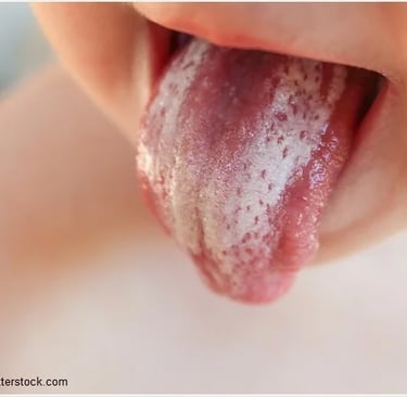 an image showing white lesions in baby tongue