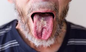 an image showing tongue with oral thrush