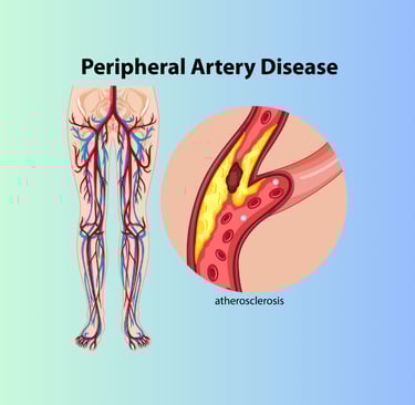 Medical diagram showing Peripheral Artery Disease (PAD) with narrowed leg arteries and reduced blood flow, illustrating sympt