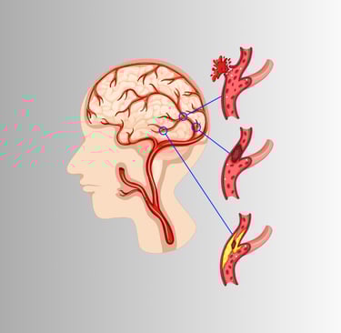 Medical illustration of an aneurysm showing a weakened, bulging section of a blood vessel wall, highlighting risks and sympto
