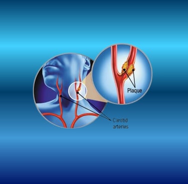 Medical illustration of Carotid Artery Disease showing plaque buildup in the carotid arteries of the neck, leading to reduced