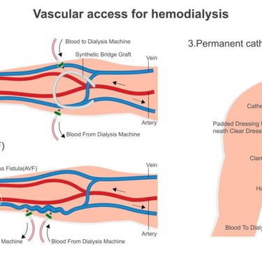 Illustration showing dialysis access types: arteriovenous fistula and graft used for hemodialysis treatment.