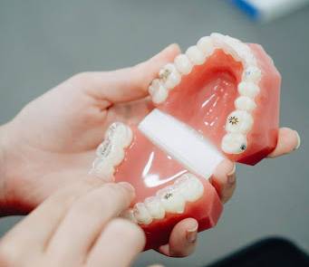 A Comprehensive Guide to Clear Aligners