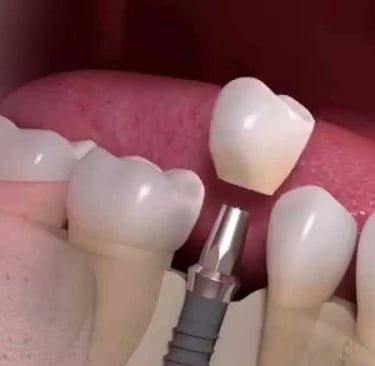 Beautify Your Smile With Dental Implants in Pune