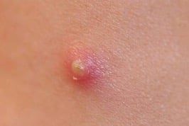 Bintik merah pada kulit