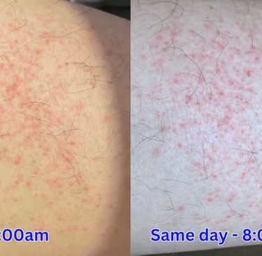 Red spots on thigh: picture left shows moderate amount 11am, pic right shows more severe 8pm