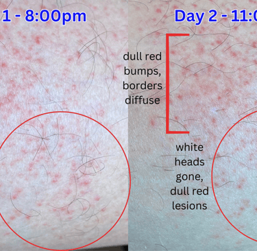 Bright red spot day 1, dull red spots day 2