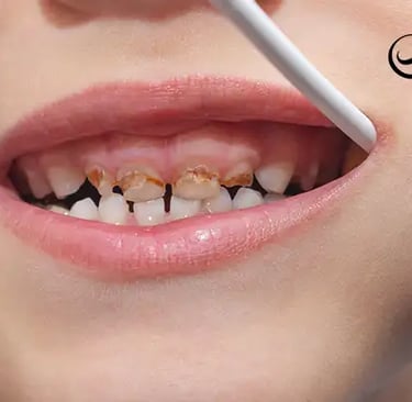 أفضل طرق علاج تسوس الأسنان للأطفال