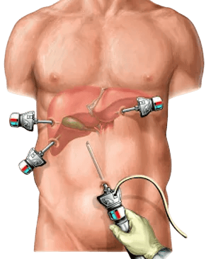 Laparoscopia para realizar colecistectomia