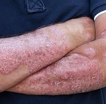 a person suffering from psoriasis