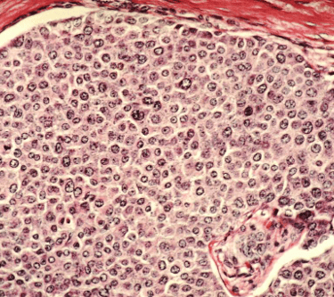 Breast Cancer cells