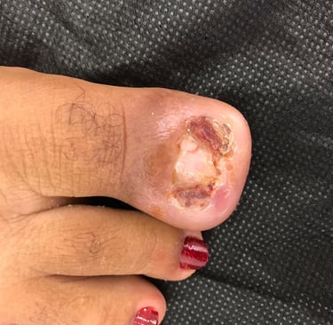 Unha encravada, Salvador/Bahia