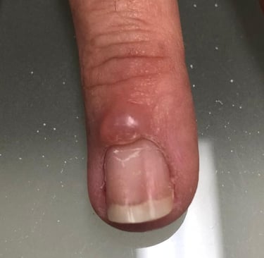 Cisto mixoide, Unhas, Salvador/ahia