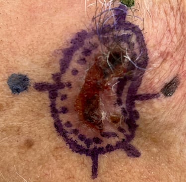 Marcação tumor para confecção mapa, Cirurgia Micrográfica de Mohs em Salvador, Bahia