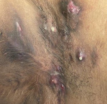 Hidradenite Supurativa, Salvador/Bahia 