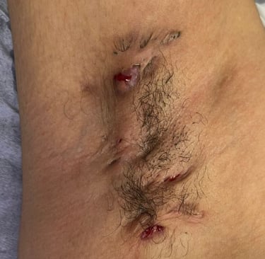 Hidradenite Supurativa, Salvador/Bahia