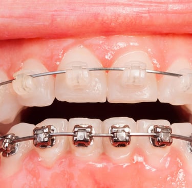 Close-up image showcasing a comparison between metal and ceramic braces on teeth.