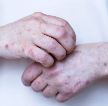 actinic keratosis