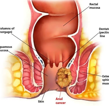 anal cancer