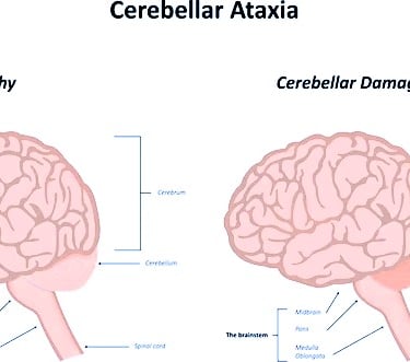 Ataxia