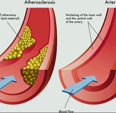 Arteriosclerosis