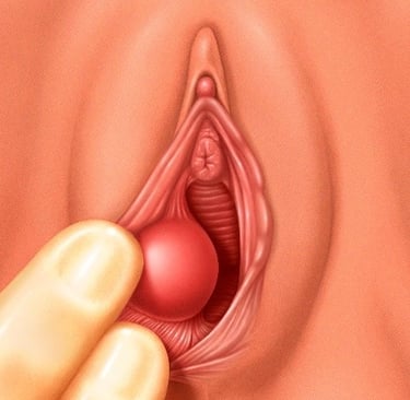 bartholin cysts