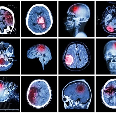 Brain Tumors