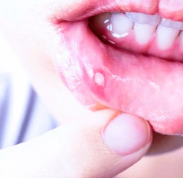 Canker sores
