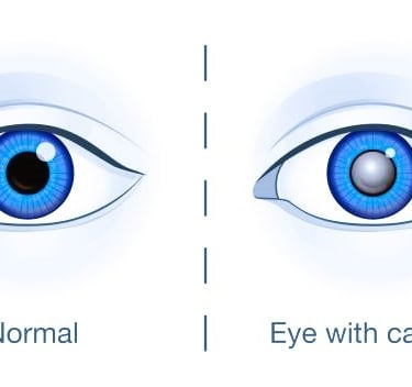 cataracts