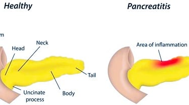 pancreatitis