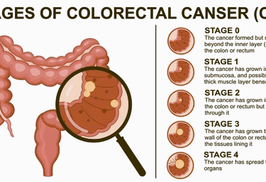 colorectal cancer