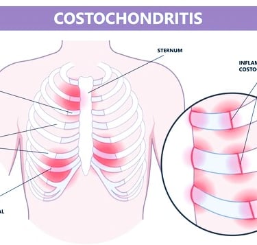 costochondritis