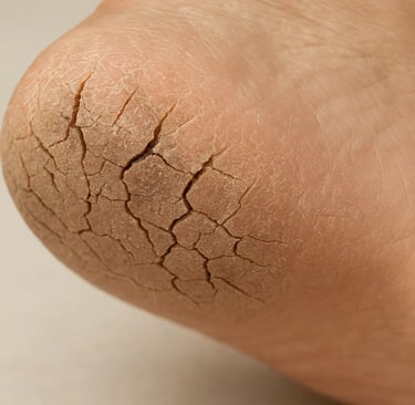 Severe cracked heels showing dry and damaged skin on foot
