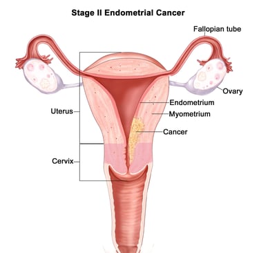 Endometrial Cancer