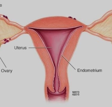 ENDOMETRIOSIS